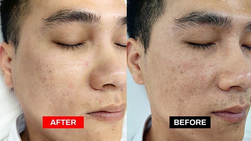 Crystallite Depth 8 RF Microneedling Machine factory