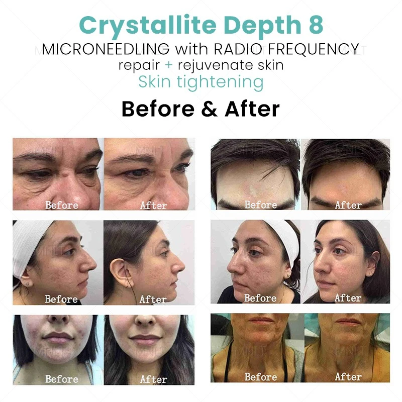 Crystallite Depth 8 RF Microneedling Machine – Advanced Skin Tightening & Body Remodeling Solution high quality