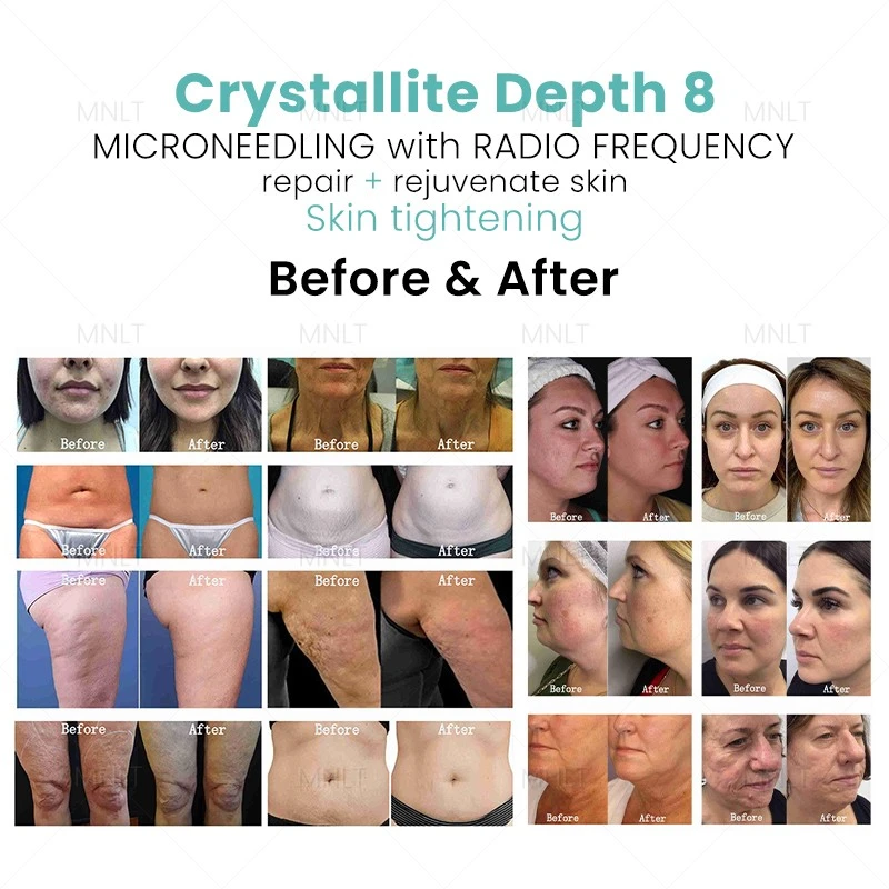 Crystallite Depth 8 RF Microneedling Machine – Advanced Skin Tightening & Body Remodeling Solution price