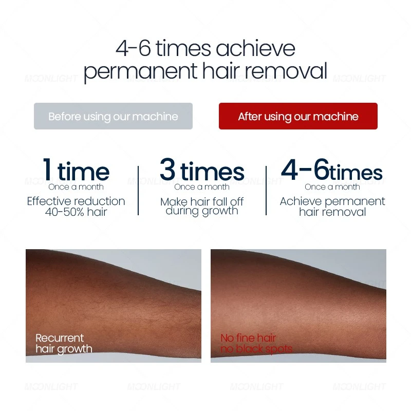 Laser Hair Removal for Dark Skin