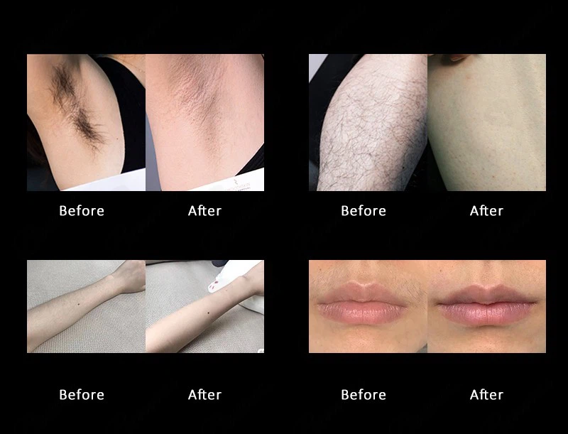 Professional Diode Laser Hair Removal Machines